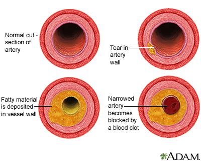 what is atherosclerosis quizlet